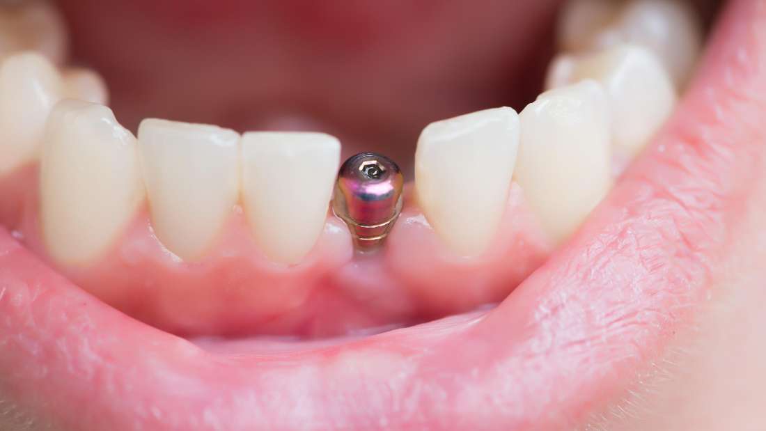 5 Ways to Help Prevent Dental Implant Failure Dental Implants Elk