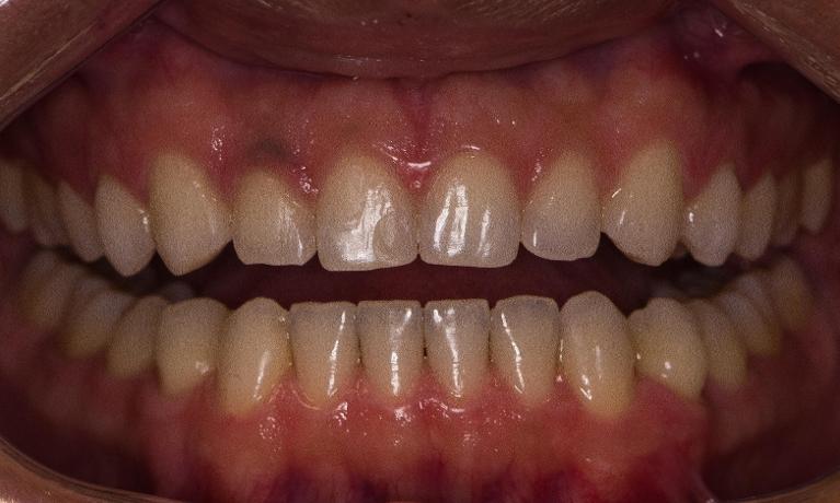 Invisalign-Orthodontic-treatment-After-Image