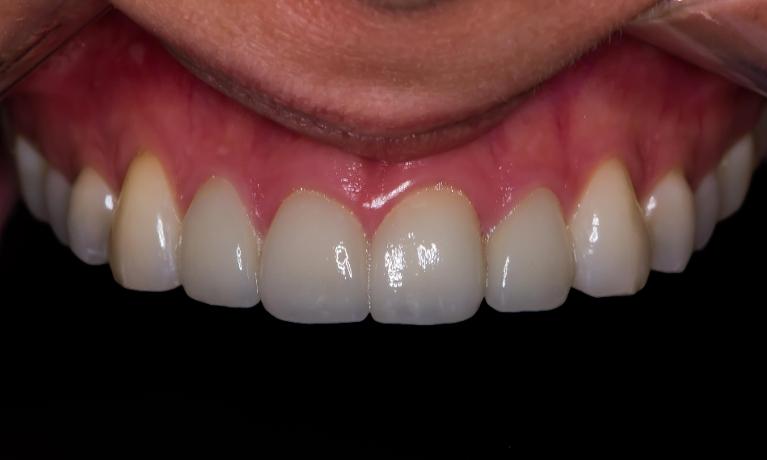 Porcelain-Veneers-on-upper-4-teeth-After-Image