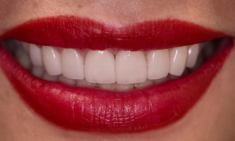Smile-Design-With-Gum-Contouring-and-Veneers-After-Image