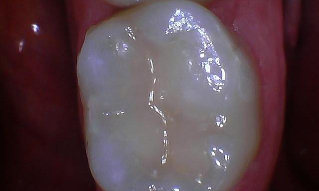 Tooth-colored-filling-After-Image