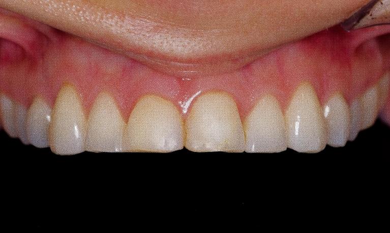 Porcelain-Veneers-on-upper-4-teeth-Before-Image