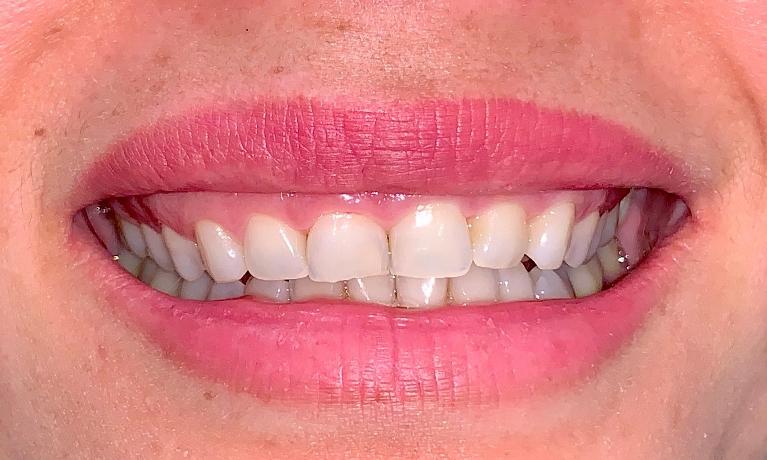 Smile-Design-With-Gum-Contouring-and-Veneers-Before-Image