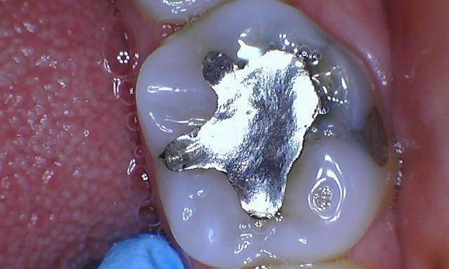 Tooth-colored-filling-Before-Image