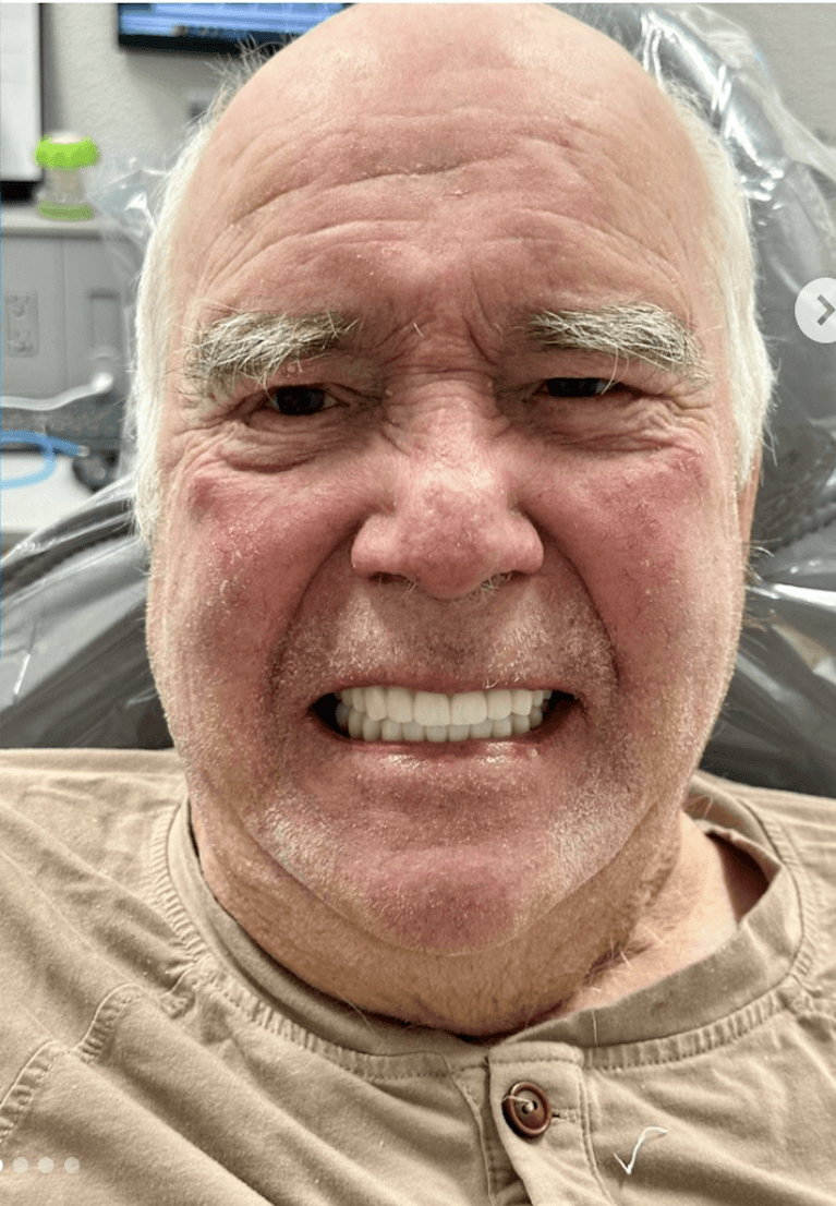 All-on-4-Implants-upper-and-lower-After-Image
