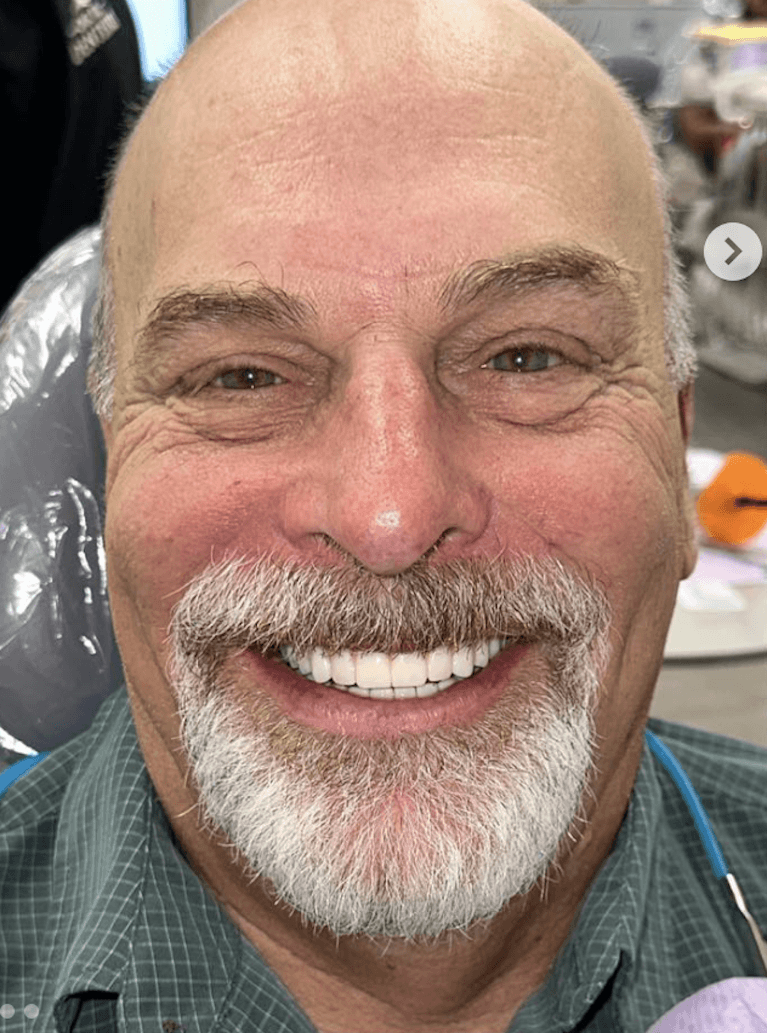 All-on-4-implant-After-Image