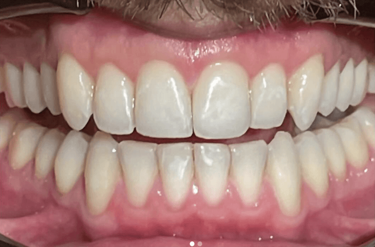 Invisalign-before-and-after-After-Image
