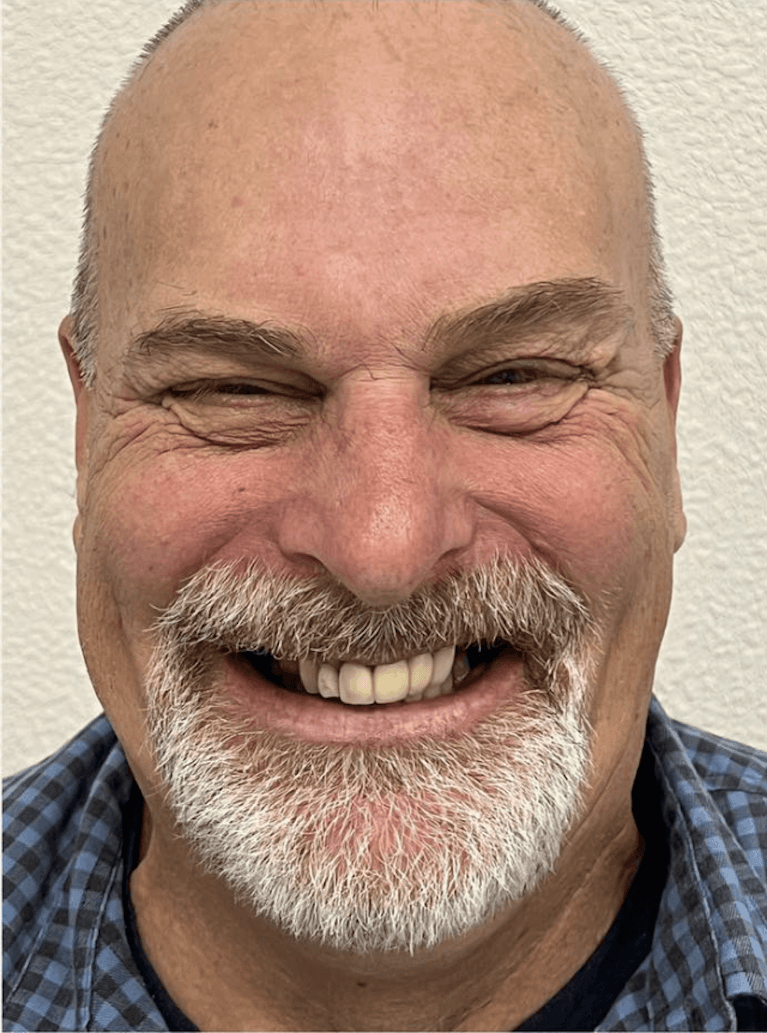 All-on-4-implant-Before-Image