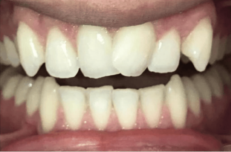 Invisalign-before-and-after-Before-Image